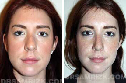 Female face, before and after Rhinoplasty treatment, front view, patient 3