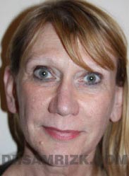 Laser Resurfacing PRP Fat after picture