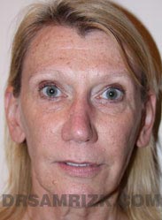 Laser Resurfacing PRP Fat before picture
