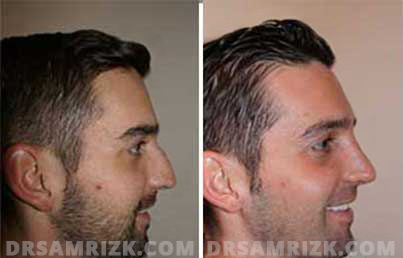 Galleries. Before and After Male Rhinoplasty Treatment , male face, side view