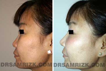 Ethnic rhinoplasty another patient before and after photo