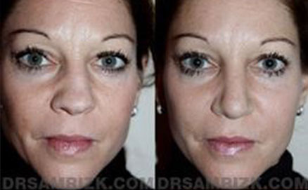 Woman patient before and after graft front photo