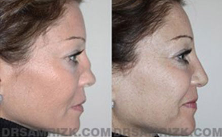 Woman patient before and after graft right side photo