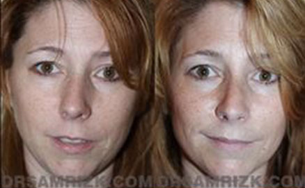 Another woman patient before and after graft front photo