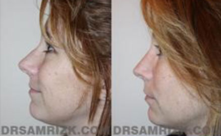 Woman patient before and after graft left side photo