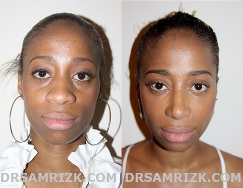 Patient before and after rhinoplasty front view
