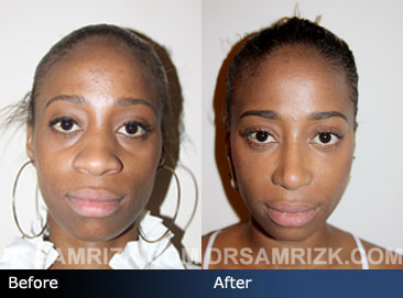 Female patient ethnic rhinoplasty before & after pics