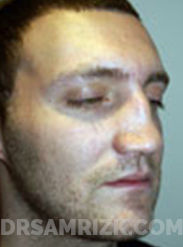 Patient face, Internet Consultation, 3/4 (oblique) view right