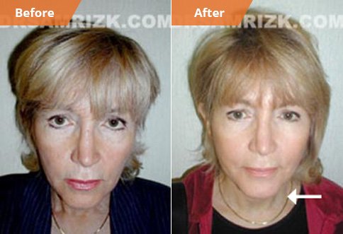 photos Before and After Facelift