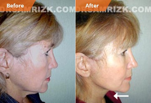 photos Female patient  Before and After Facelift