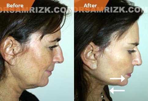 photos Female patient  Before and After Facelift