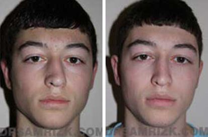 Patient 3 Set1 before and after rhinoplasty