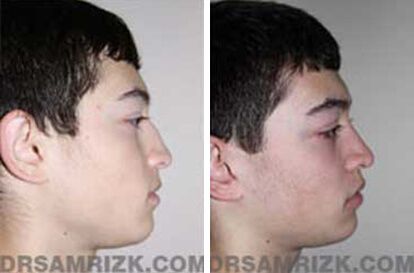 Patient 3 Set2 before and after rhinoplasty