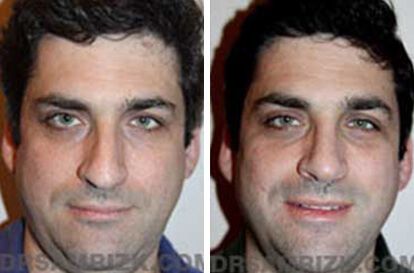 Patient 2 Set1 before and after rhinoplasty