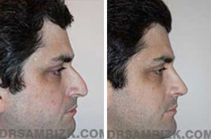 Patient 2 Set2 before and after rhinoplasty