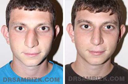 Patient 4 Set1 before and after rhinoplasty