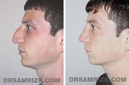 Patient 4 Set2 before and after rhinoplasty