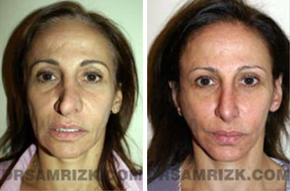 Patient 1 Set1 before and after rhinoplasty women
