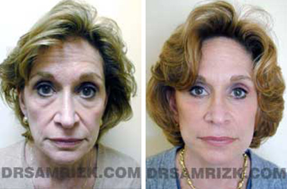 Patient 3 Set1 before and after rhinoplasty women