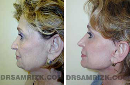 Patient 3 Set2 before and after rhinoplasty women