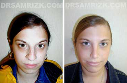 Patient 2 Set1 before and after rhinoplasty women
