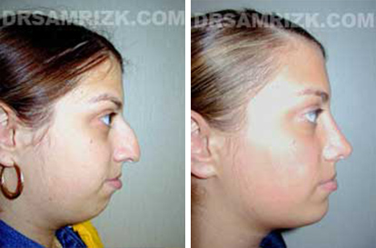 Patient 2 Set2 before and after rhinoplasty women