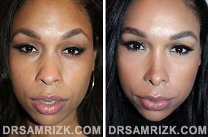 Patient 11 Set1 before and after nose surgery