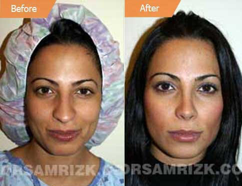 Rhinoplasty Surgery Austin