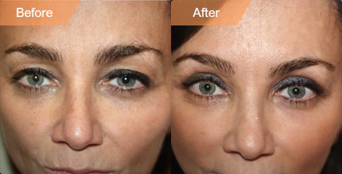 Woman's face, before and after Mini Facelift treatment, front view, patient 3