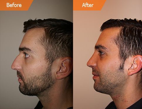 Rhinoplasty Cost NYC | Nose Job Cost New York