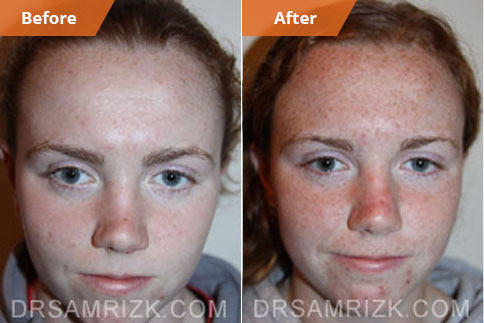 Damaged Nose Bridge with Deviated Septum 