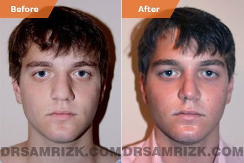 Damaged Nose Bridge with Deviated Septum 