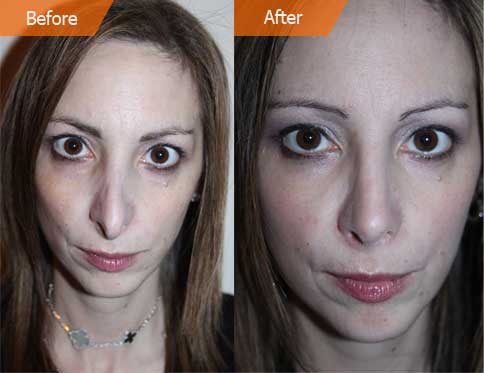 Before and After Revision Rhinoplasty