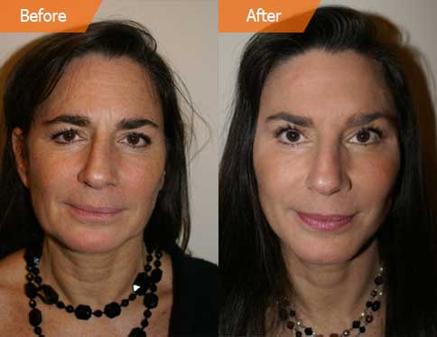 Woman's face, before and after Mini Facelift treatment, front view, patient 2