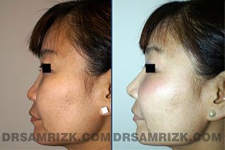 Before and after rhinoplasty gallery