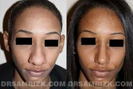 18 yo African American patient who underwent rhinoplasty with medpor implant and nostril reduction. Patient is shown 6 months post-surgery and although there is still some tip swelling, the general structure of tip and dorsum is much more refined. Additionally the incisions of the nostrils are on inside of nostril rather than on outside where it joins the face.