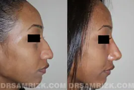 18 yo African American patient who underwent rhinoplasty with medpor implant and nostril reduction. Patient is shown 6 months post-surgery and although there is still some tip swelling, the general structure of tip and dorsum is much more refined. Additionally the incisions of the nostrils are on inside of nostril rather than on outside where it joins the face.