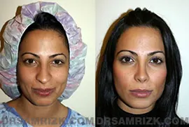 A female patient in her mid twenties is shown here before surgery. The two other postoperative images show the successful outcome six months and two years after the surgery. The drooped end of her nose was lifted and the overall shape was modified to look more natural.