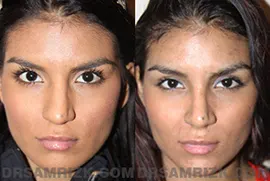 22 year old female who underwent endonasal 3D nose surgery to lift her tip, remove her bump and narrow the tip. Patient is shown postoperatively. Note that patient has a history of using a nose ring on the left side and has a slight indentation asymmetry from the nose ring.
