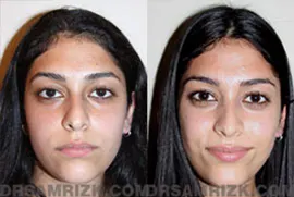22 year old Middle Eastern female underwent 3D endonasal minimally invasive rhinoplasty to remove the nasal bump and refine the nasal tip. This Middle Eastern rhinoplasty patient has a typical tip drop found in Middle Eastern rhinoplasty patients and the tip was also elevated. Dr. Rizk's aesthetics is a feminine but natural profile as shown. Every nose Dr. Rizk performs is different as is every profile which must be in harmony with the rest of the face. Patient is shown post-surgery at 6 months.