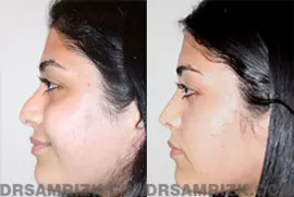 22 year old Middle Eastern female underwent 3D endonasal minimally invasive rhinoplasty to remove the nasal bump and refine the nasal tip. This Middle Eastern rhinoplasty patient has a typical tip drop found in Middle Eastern rhinoplasty patients and the tip was also elevated. Dr. Rizk's aesthetics is a feminine but natural profile as shown. Every nose Dr. Rizk performs is different as is every profile which must be in harmony with the rest of the face. Patient is shown post-surgery at 6 months.