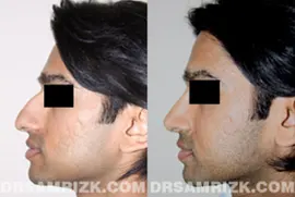 25 yo female wishes to improve drooping nasal tip, bump and bulbous nasal tip. Patient underwent open rhinoplasty with tip support with her own septum cartilage to achieve a better long term result of tip support. Tip was also refined with cartilage reduction and suture techniques, and bump was removed naturally. Patient is shown 1 year after nose surgery.