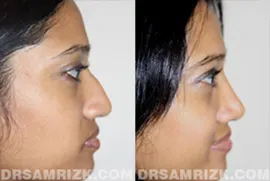 25 year old Indian/middle eastern patient with typical ethnic rhinoplasty characteristics of thick tip skin, wide nostrils, drooping nasal tip and weak tip support.