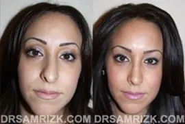 25 yo female wishes to improve drooping nasal tip, bump and bulbous nasal tip. Patient underwent open rhinoplasty with tip support with her own septum cartilage to achieve a better long term result of tip support. Tip was also refined with cartilage reduction and suture techniques, and bump was removed naturally. Patient is shown 1 year after nose surgery.