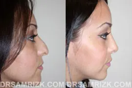 25 yo female wishes to improve drooping nasal tip, bump and bulbous nasal tip. Patient underwent open rhinoplasty with tip support with her own septum cartilage to achieve a better long term result of tip support. Tip was also refined with cartilage reduction and suture techniques, and bump was removed naturally. Patient is shown 1 year after nose surgery.