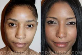 This 30 year old female Dominican patient concerned with the appearance of her nasal bump, wide nostrils and nasal tip visited Dr. Rizk for a rhinoplasty. In order to achieve a natural outcome, Dr. Rizk had to use structural nasal grafts which is different from the traditional techniques of excision of cartilage. Overall the patient was satisfied with her results, shown in the picture 4 months after surgery.
