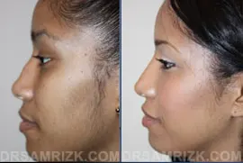 This 30 year old female Dominican patient concerned with the appearance of her nasal bump, wide nostrils and nasal tip visited Dr. Rizk for a rhinoplasty. In order to achieve a natural outcome, Dr. Rizk had to use structural nasal grafts which is different from the traditional techniques of excision of cartilage. Overall the patient was satisfied with her results, shown in the picture 4 months after surgery.