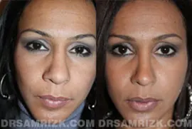 29 yo female ethnic rhinoplasty patient with thick skin who had previous rhinoplasty who requests improvement in symmetry, breathing and definition. Patient underwent revision rhinoplasty with multiple cartilage grafts into tip and middle nasal vault to correct her breathing and cosmetic appearance. Patient is shown one year after revision procedure.