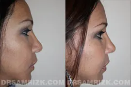 29 yo female ethnic rhinoplasty patient with thick skin who had previous rhinoplasty who requests improvement in symmetry, breathing and definition. Patient underwent revision rhinoplasty with multiple cartilage grafts into tip and middle nasal vault to correct her breathing and cosmetic appearance. Patient is shown one year after revision procedure.