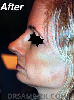 female patient after Facelift